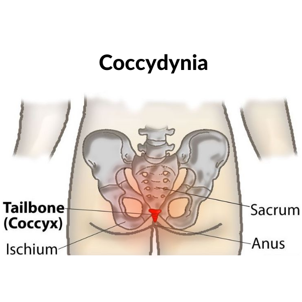 Tailbone pain cause, symptoms and treatment with 5 exercises