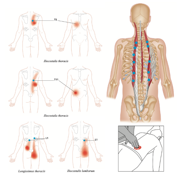 Terapia de puntos gatillo para el dolor lumbar