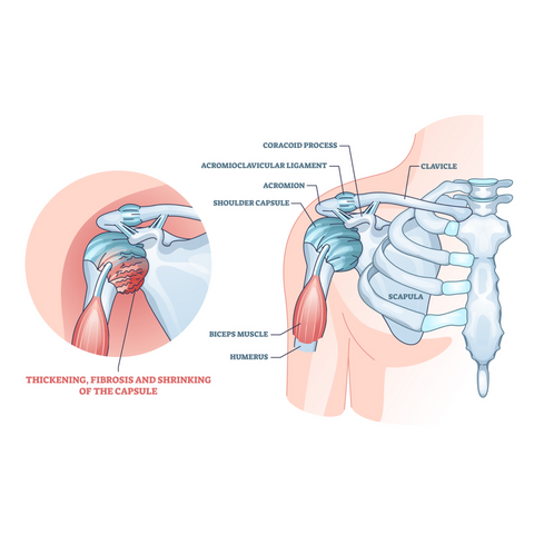 Frozen Shoulder Image