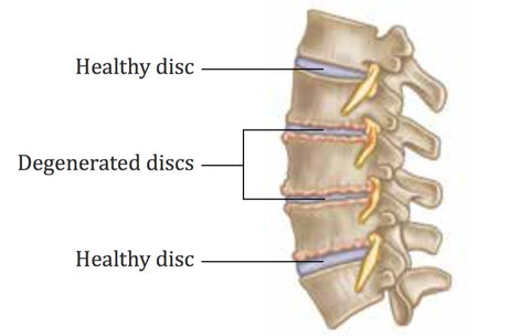 Degeneración discal y puntos gatillo