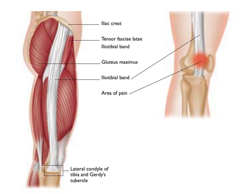 Iliotibial-Band-Syndrom