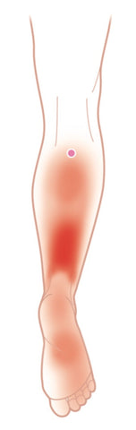 Tibialis Posterior Trigger Point - Typical Pain Pattern