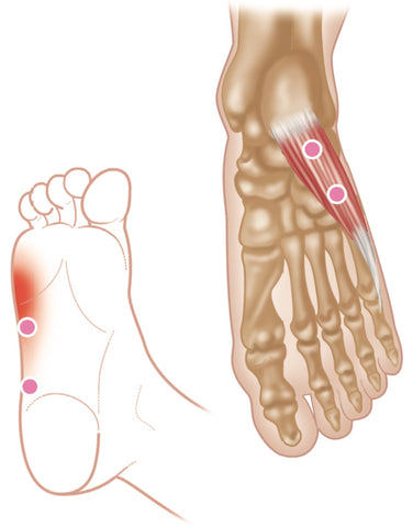 Abductor Digiti Minimi Trigger Points