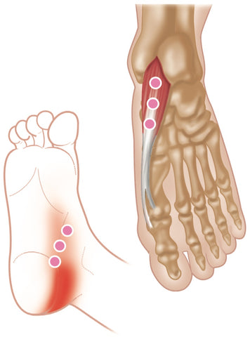 Trigger Points Abductor Hallucis