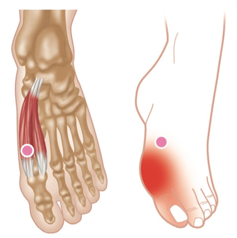 Flexor hallucis brevis Triggerpunkte