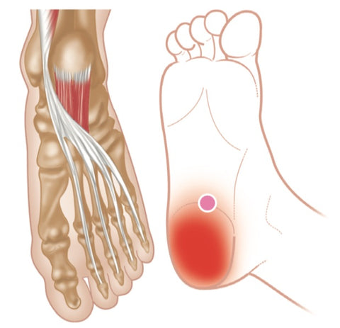 Quadratus Plantae Trigger Points