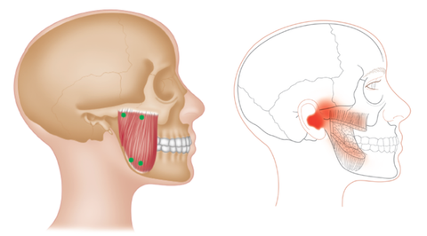 Masseter Trigger Points TMJD