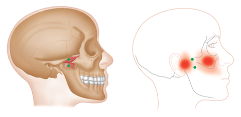 Medial Pterygoid Trigger Points