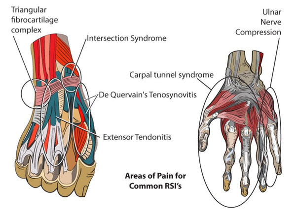 Wrist Pain Trigger Points