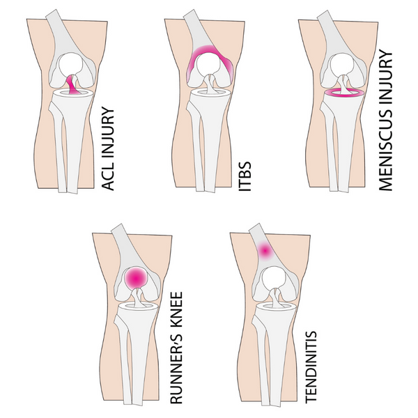 Runners Knee PFPS - Types of Knee Injury