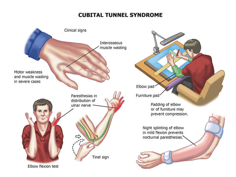 Trigger Point Therapy - Cubital Tunnel Syndrome, Cubital Tunnel Syndrome,  Elbow and more