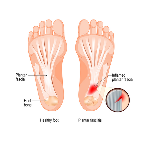 fascitis plantar