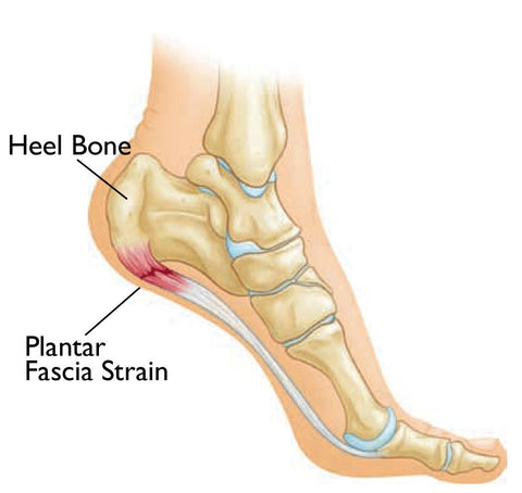 Masaje de puntos gatillo de fascitis plantar