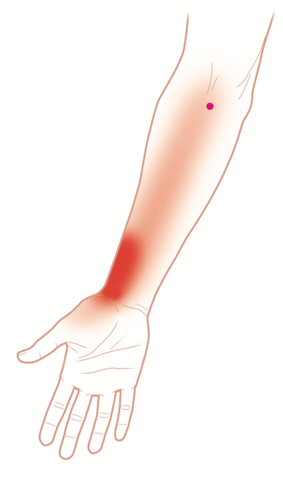 Pronator Teres Trigger Points