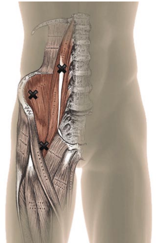 Psoas Trigger Points