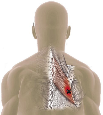 Rhomboid Muscles Trigger Points