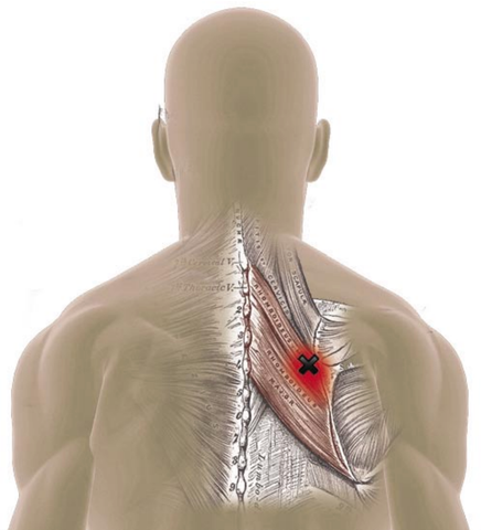 Triggerpunkte der Rautenmuskeln