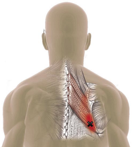 Rhomboid Muscles - Trigger Point Referred Pain