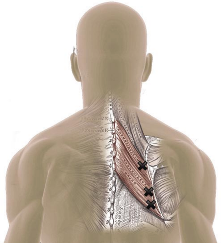 Rhomboid Muscles Trigger Points