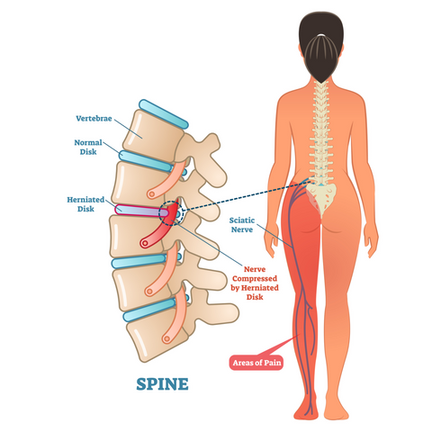 Sciatic Pain Image