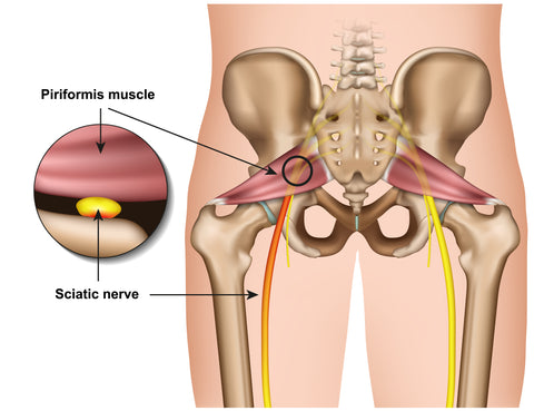 Sciatica and Piriformis Syndrome