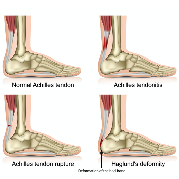Achillessehnenverletzungen