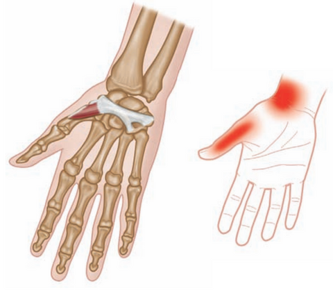 Opponens Poliicis - typical referred pain pattern