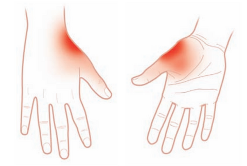 Adductor pollicis Trigger point referred pain