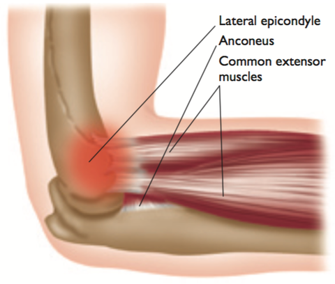 Tennis Elbow Trigger Point Therapy