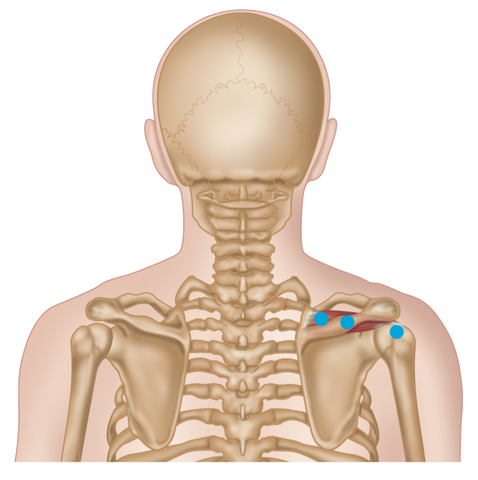 Supraspinatus-Triggerpunkte