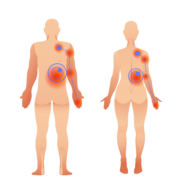 Serratus posteriorer unterer und oberer Triggerpunkt