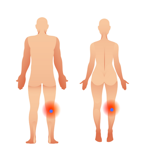 Popliteus Trigger Point Pain Referral