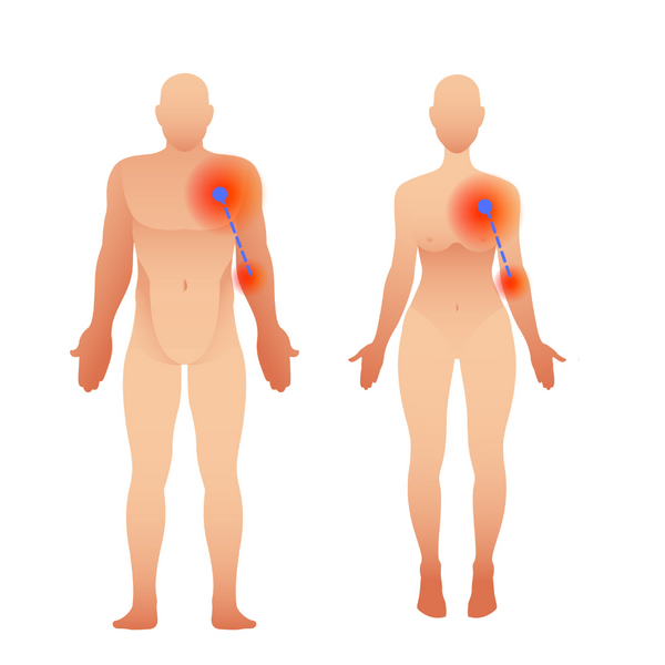 Pectoralis Minor Trigger Point Symptoms