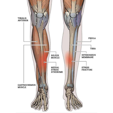 Medial Tibial Stress Syndrome