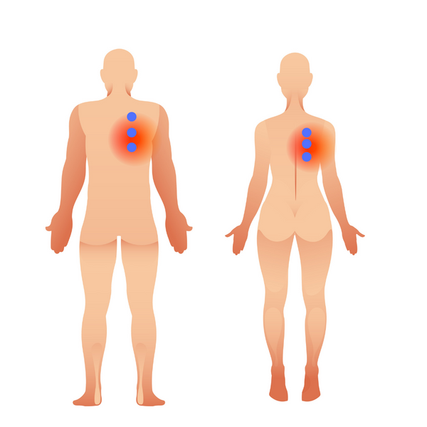 Rhomboid Pain / Interscapular Pain