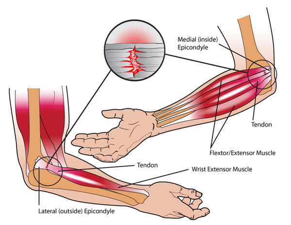 Trigger Point Therapy Tennis Elbow
