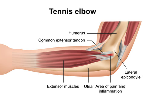 Anatomie des Tennisellenbogens