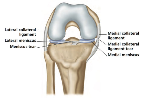 Articulación de la rodilla MCL Dolor y dolor de menisco
