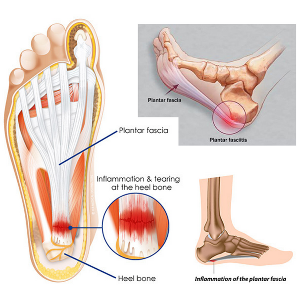 Tratamiento del dolor de talón