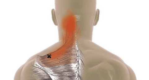 Trapezius Trigger Points