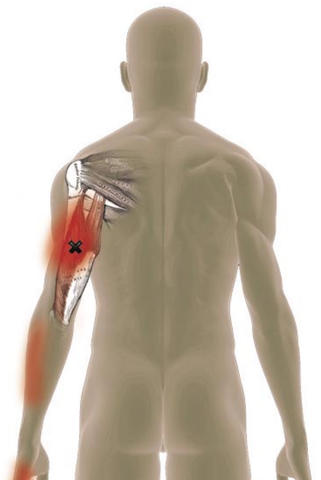 Liberación del punto de activación del tríceps