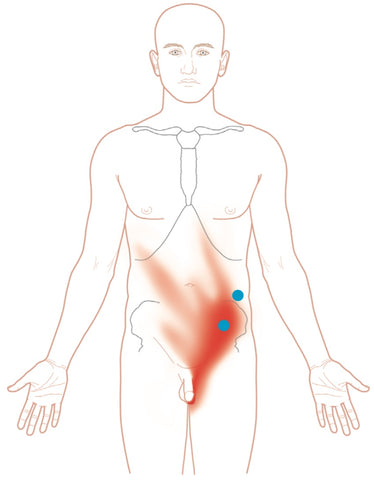 Transversus Abdominis - Puntos gatillo