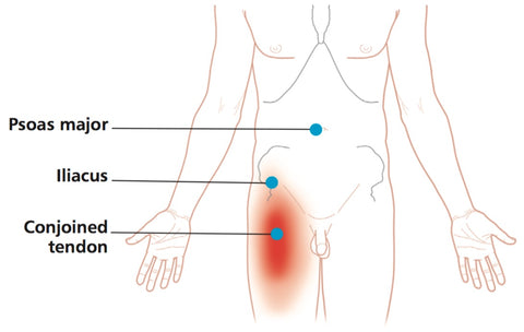 psoas pain referral pattern