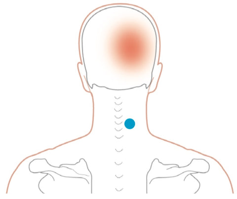 Semispinalis capitis (medio) y cervicis Puntos gatillo