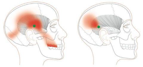 Terapia de puntos gatillo - Temporalis