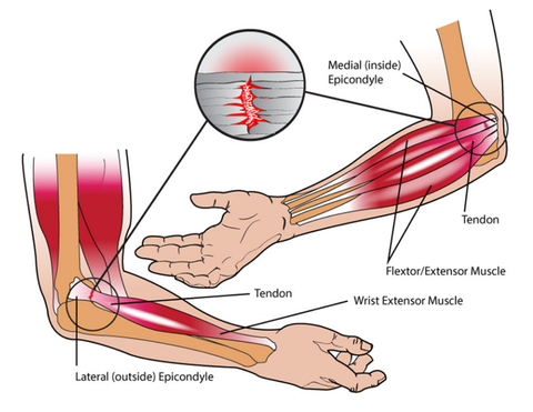 Vacuum Cupping for Lateral Elbow Pain – Stuart Hinds Performance ...