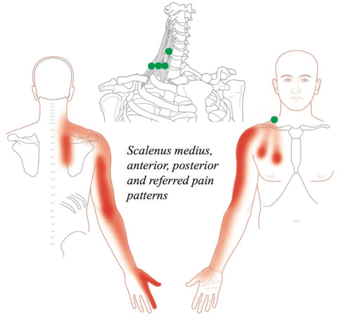 Trigger Point Therapy for Thoracic Outlet Syndrome (TOS) – Stuart Hinds  Performance Therapy