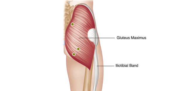 Gluteus Maximus and ITB Trigger Points