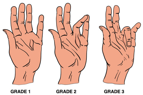 Puntos gatillo de la contractura de Dupuytren