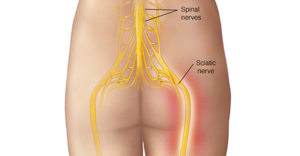 Diagram of the sciatic nerve as it branches from the spine